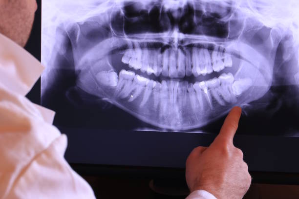 Best Emergency Dentist for Lost Fillings or Crowns in Havana, IL